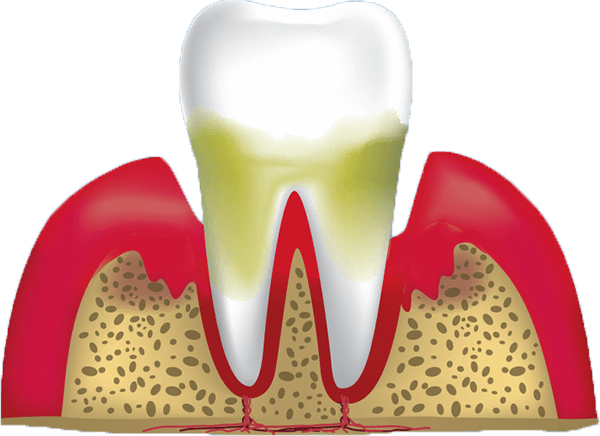 gum disease stage 4