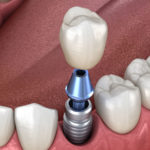 Navigating Your Way to the Best Oral Surgeon Near Columbia, MD