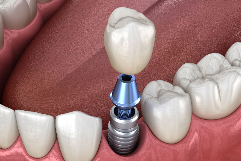 Navigating Your Way to the Best Oral Surgeon Near Columbia, MD