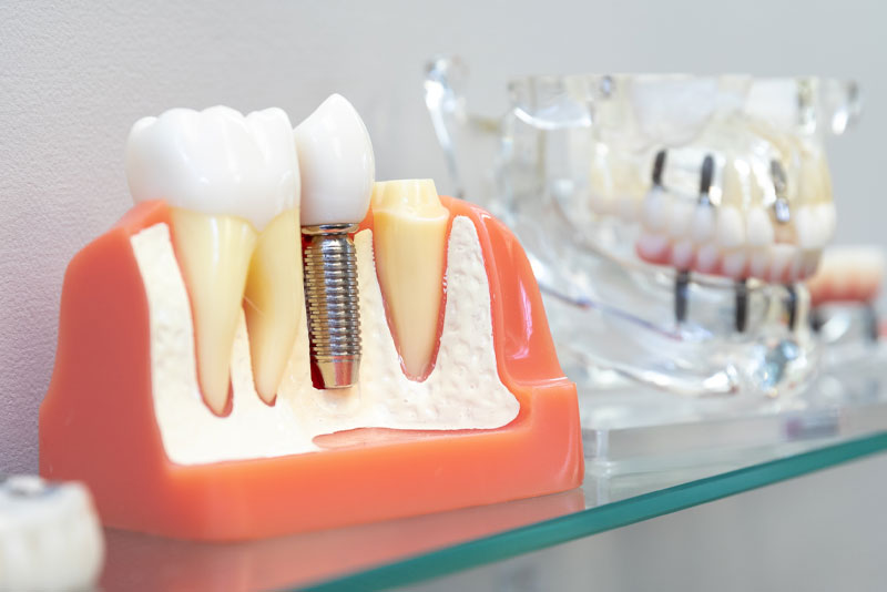 Comprehensive Guide to Dental Implants in Baltimore MD by Expert Oral Surgeons