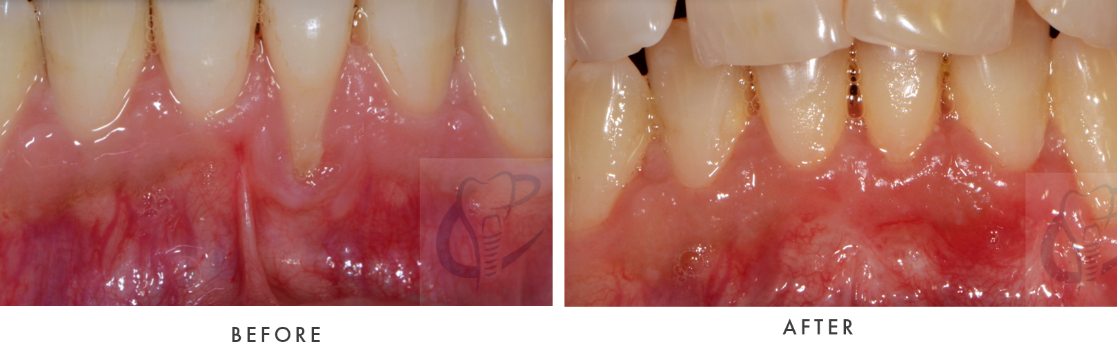 Gum graft