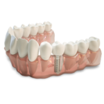 Which Types Of Cosmetic Periodontal Treatments In Columbia, MD Can I Get Treated With?