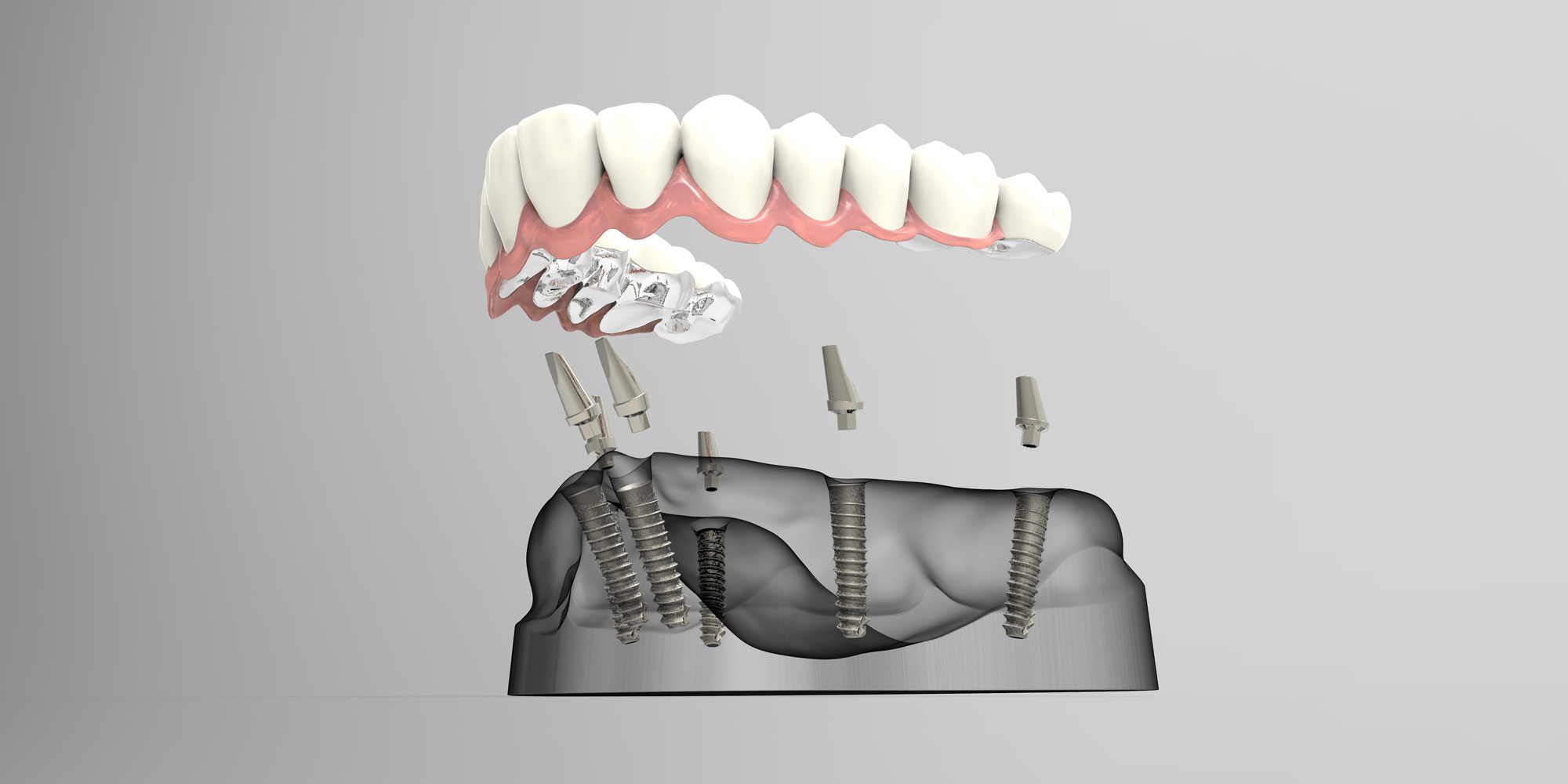 dental implant placement