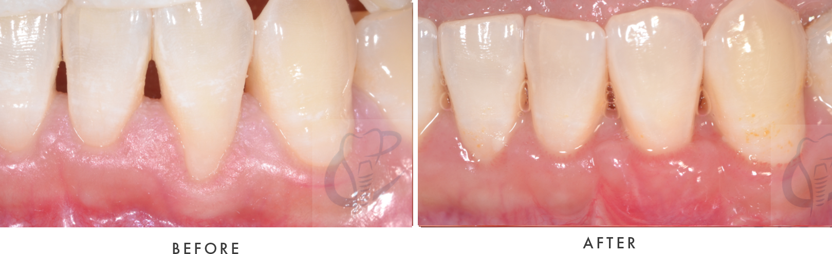 gum graft