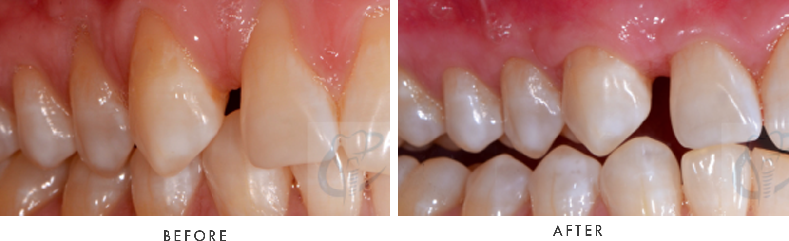 gum graft