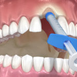 Do I Need Bone Grafting Before A Dental Implant Treatment?