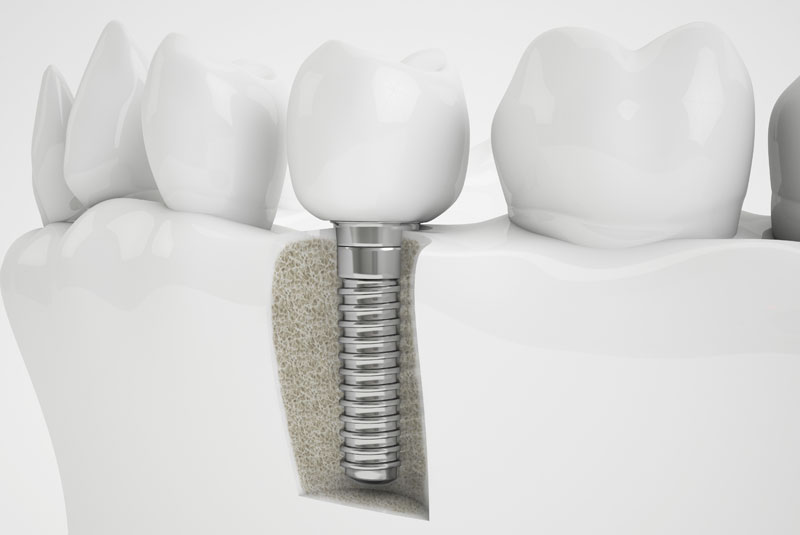 When Getting Dental Implants, How Does Bone Grafting Help Me?