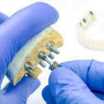 Is It Possible For Me To Get Customized Dental Implant Treatments?