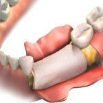 Should I Get Dental Implants After A Bone Grafting Procedure?