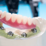 Will My Smile Be Stable And Comfortable With Implant Supported Dentures?