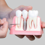 Are There Specific Parts That Make Up A Dental Implant?