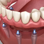 Will Implant Supported Dentures Give Me A More Stable Smile Than Traditional Dentures?