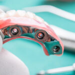 Is There A Difference Between Implant Supported Dentures And Full Mouth Dental Implants?