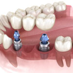 After Having A Tooth Extraction, Should I Get Treated With Dental Implants In Columbia, MD?