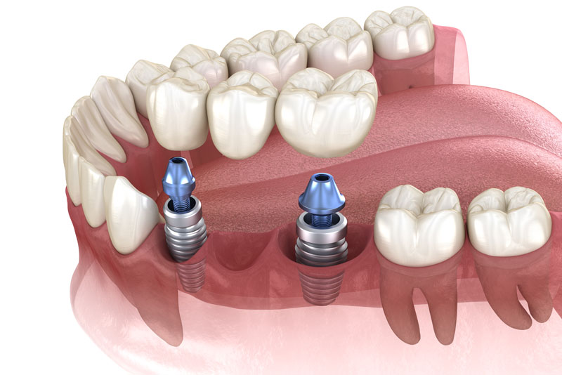 3d rendered image of dental implants being installed.