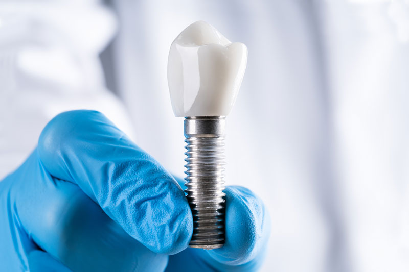 Which Types Of Dental Technologies Can Be Used To Place Dental Implants In Columbia, MD?