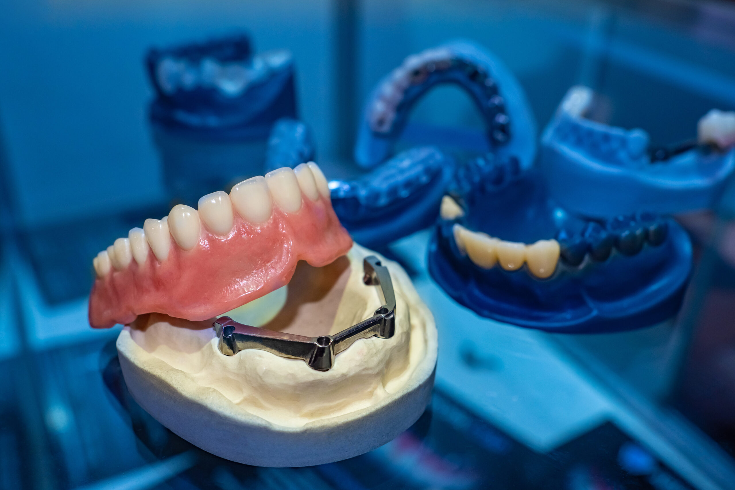Does Anything Happen To My Jawbone If I Don’t Immediately Replace My Missing Teeth With Dental Implants?