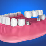 Am I A Candidate For Implant Supported Dentures?
