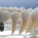 After My Dental Implants Are Placed, How Will I Know If I Have Peri-Implantitis?