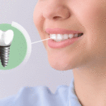 Can I Upgrade My Smile From Traditional Dentures To Implant Supported Dentures?