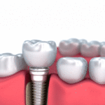 Should I Get Treated With Dental Implants After Tooth Extractions?