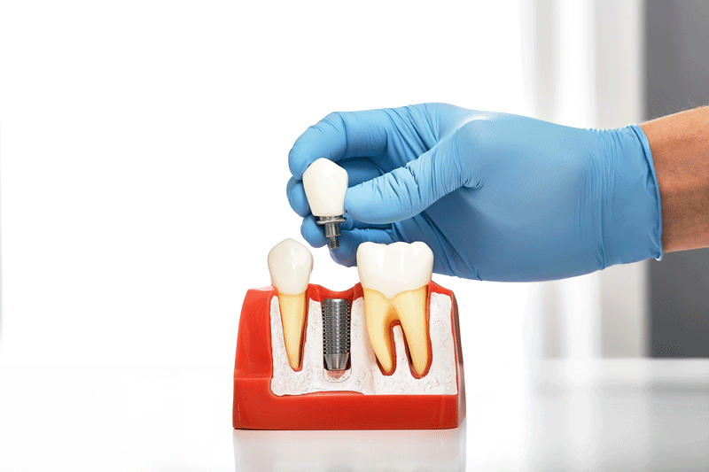 Dentist showing the installation of a dental implant on the anatomical model of teeth