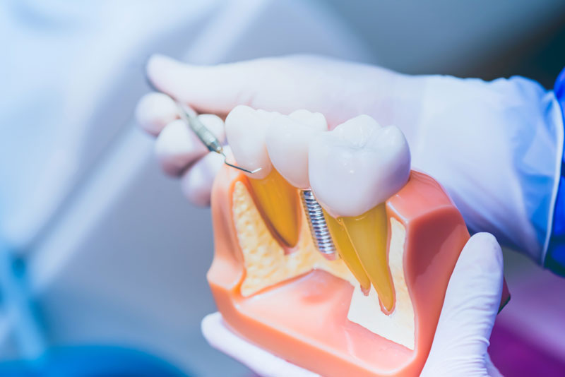In What Ways Do Dental Implants Benefit My Smile?