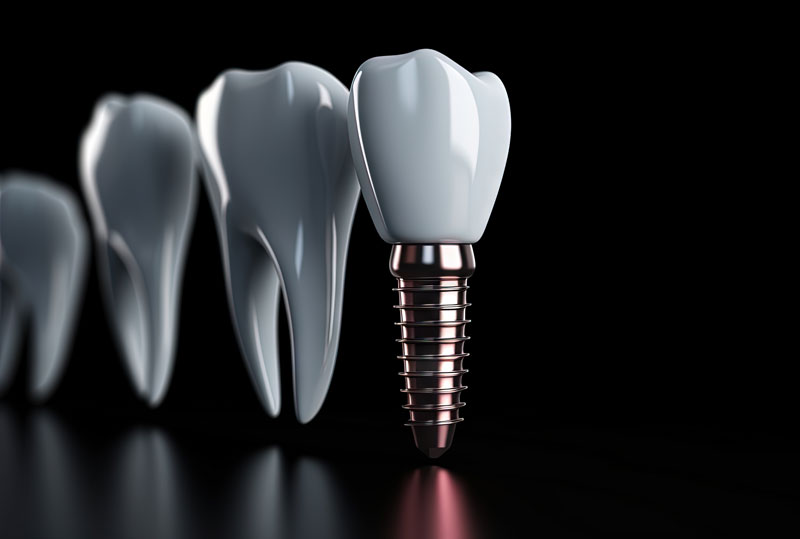 Are There Risks To Getting Treated With Dental Implants?