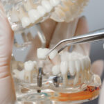 Why Can’t I Taste With Dentures, But Can With Dental Implants?