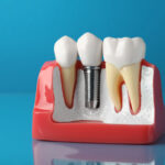 What Complications Can Occur With Dental Implant Placements?