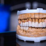 Which Factors Determine The Cost Of Dental Implants?