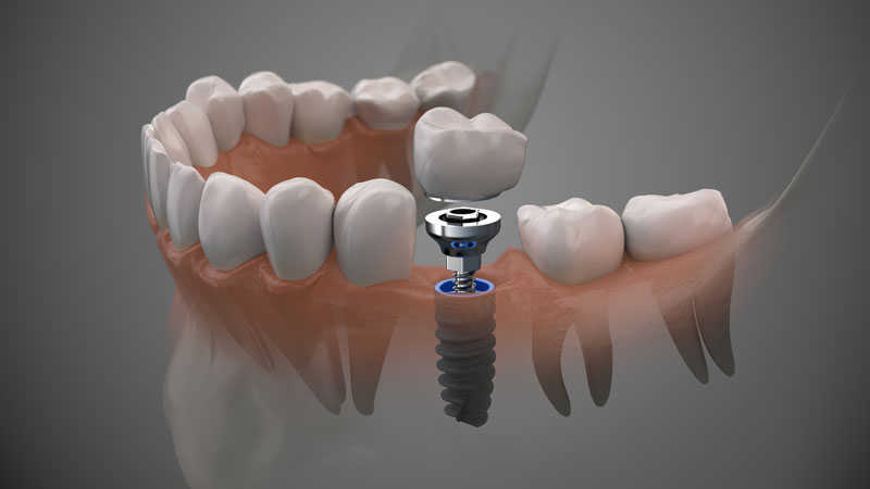 A Comprehensive Walkthrough of Stages of Dental Implants