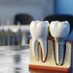Navigating the Price for Tooth Implants: An In-depth Breakdown