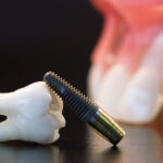 Are Dental Implants Worth the Cost?