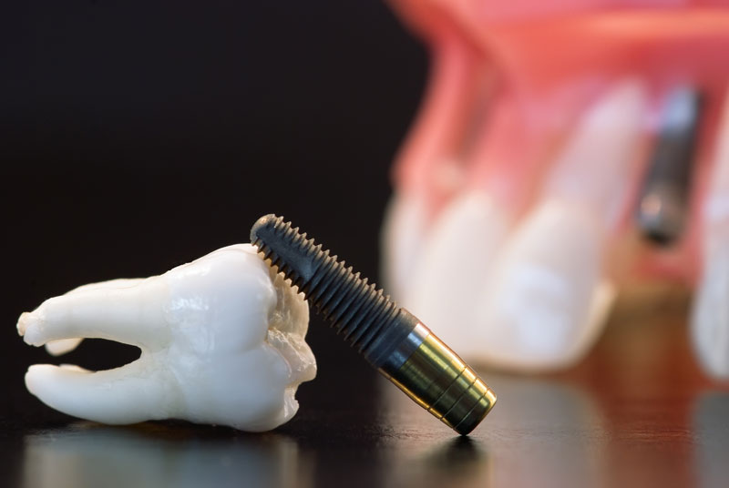 Are Dental Implants Worth the Cost?