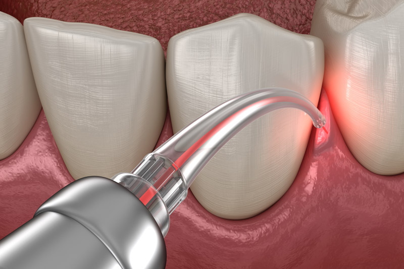 Lanap laser gum surgery.