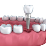 Understanding Your Abutment on Implant: A Comprehensive Guide to Dental Implants Success