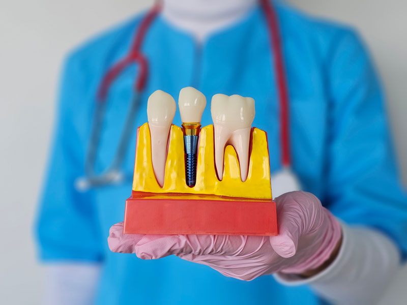 Exploring Your Options: Different Types of Dental Implants for a Confident Smile