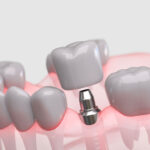The Complete Dental Implant Process: Your Comprehensive Patient Guide