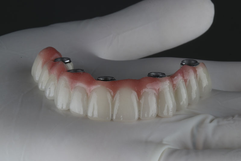 All on 4 in Howard County MD: A Comprehensive Guide from Oral Surgeons