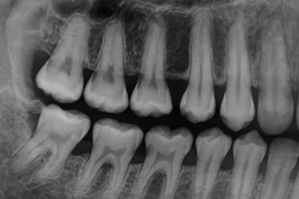 An x-ray of a jaw bone with visible bone loss around the teeth. No text on image.