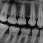 What Causes Bone Loss In Your Mouth? Gum Disease, Explained.